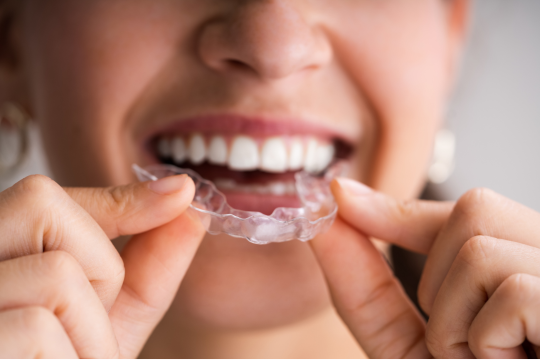 Clear aligners step by step